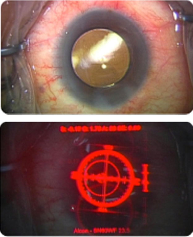 眼内レンズ（IOL）を挿入後、再度計測