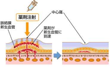 硝子体注射とは