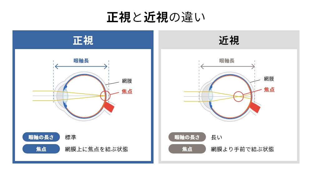 【白内障と近視】白内障手術で近視は治る？ - ライトアジャスタブルレンズ LAL｜中京眼科