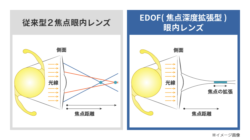 「従来型2焦点眼内レンズ」と「EDOF（焦点深度拡張型）」眼内レンズの違い